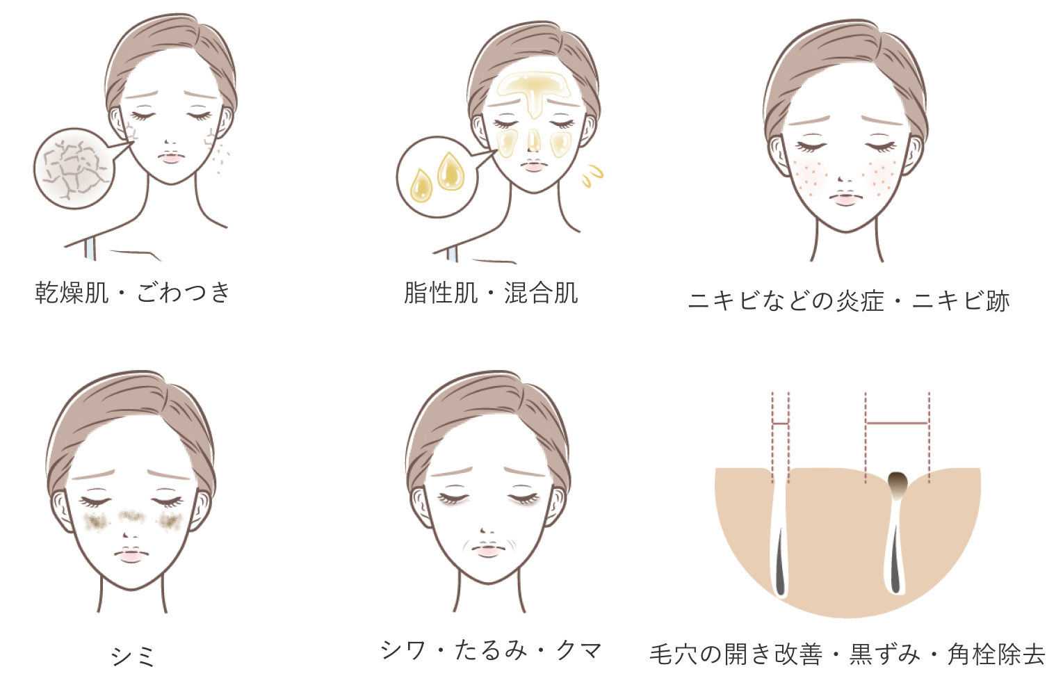 たるみ、切らずにリフトアップ、肌のハリ、ほうれい線、目元の老化対策、二重アゴをなくしたい